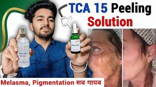 Tca 15 Chemical Peel Review  TCA 15 Peel How to Use  At Home Chemical Peel [upl. by Citarella344]