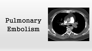 Pulmonary Embolism [upl. by Sax]