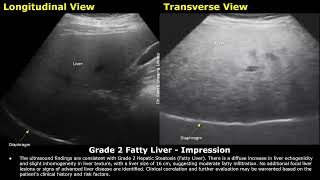 Grade 2 Fatty Liver Ultrasound Report Example  Diffuse Hepatic Steatosis Sonography  Abdominal USG [upl. by Argile]