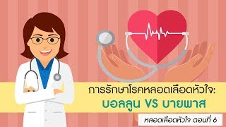 หลอดเลือดหัวใจ ตอนที่ 6 การรักษาโรคหลอดเลือดหัวใจด้วยบอลลูน VS บายพาส [upl. by Suidualc899]