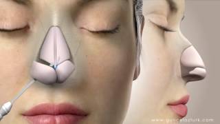 Rhinoplasty Nose Job Video Animation  Guncel Ozturk MD  DRGO [upl. by Ahsekam963]