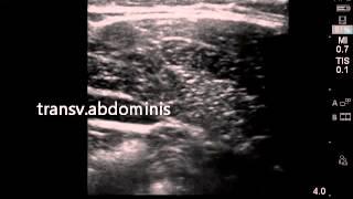 Ultrasound guided transversalis fascia plane block [upl. by Zadoc]