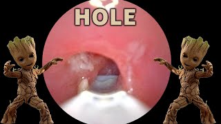 My Stinky Hole Tonsil Stones  AIM 28 [upl. by Notserc]