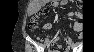 Lipomatosis of the ileocecal valve [upl. by Annodahs]