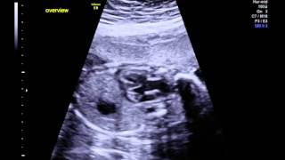 Tetralogy of Fallot with pulmonary stenosis overview [upl. by Hayouqes667]