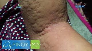 Pinoy MD Labis na pamamantal sanhi ng urticaria [upl. by Reteid964]