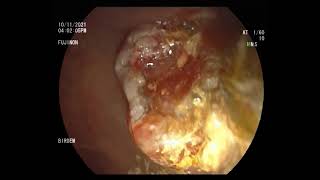 choledocholithiasis with cholangitis stone extraction [upl. by Elleinet]