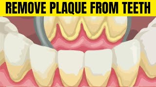 How to Remove Plaque from Teeth at Home The Ultimate Guide [upl. by Wardlaw]