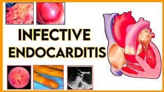 infective endocarditisetiologypathogenesisclassificationsign and symptomdiagnosis and treatment [upl. by Ayat]