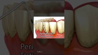 Periodontitis and Laser Hardening Surgery 3D Animation [upl. by Staten782]