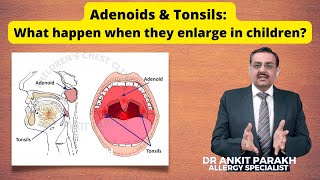 Adenoids amp Tonsils What happen when they enlarge in children I Dr Ankit Parakh Child Pulmonologist [upl. by Hafeenah616]