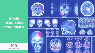 Brain Herniation syndromes Types Symptoms and Treatment [upl. by Eatton]