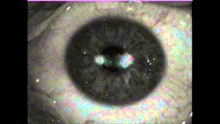 My left eye Topoguided PRKCXL laser surgery on 20140828 [upl. by Assenov]