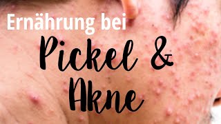 5 Ernährungstipps bei Pickel und Akne  Satte Sache  Ernährungsmedizin amp Wissenschaft [upl. by Leopoldine520]