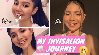 I HAD INVISALIGN FOR 2 YEARS  do I regret it what I wish I knew BEFORE tips [upl. by Kablesh]