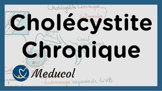 Cholécystite chronique calcul vésicule biliaire symptômes inflammation et cholécystectomie [upl. by Treva]