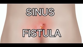 Discussion on Sinus amp Fistula  FB live  28062020 [upl. by Sauncho]