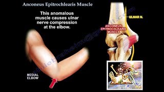 Anconeus Epitrochlearis Muscle cubital tunnel  Everything You Need To Know  Dr Nabil Ebraheim [upl. by Emmi]