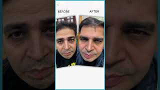 Forehead Botox Before and After  Best Clinics in Delhi for WrinkleFree Foreheads  AWISH Clinic [upl. by Ynetruoc]