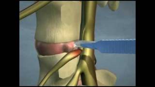 Lumbar Disc Herniations [upl. by Ramel]