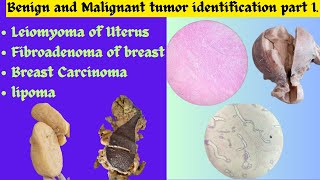 Leiomyoma of Uterus Fibroadenoma of breast Breast Carcinoma Lipoma identificationPatho exam OSPE [upl. by Tsepmet]