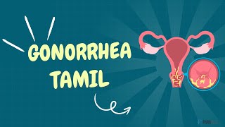 Gonorrhea in Tamil Definition Symptoms Causes Diagnosis and Management [upl. by Rustie]