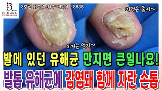 💦무좀 손톱💦발톱에 있던 유해균이 손톱으로 손톱도 이렇게 될 수 있어요 😣 발톱닥터 무좀발톱 무좀발톱스케일링 무좀발톱관리 지축역 무좀손톱 [upl. by Hedwiga]