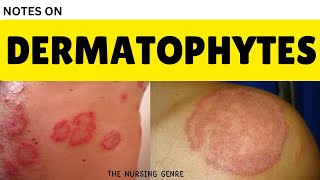 DERMATOPHYTES  Dermatophytosis  Skin diseases  ringworm skininfection skin skincare [upl. by Leahcimal]