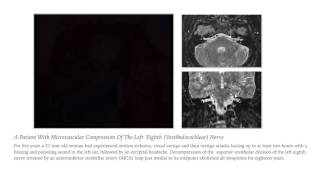 Vestibular Paroxysmia or 8th Nerve Microvascular Compression Syndrome [upl. by Nosirb]