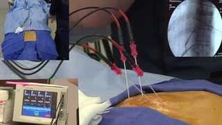 Radiofrequency Ablation Explanation Video Demonstration  LIVE [upl. by Irrep384]