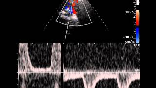 SUBCLAVIAN ARTERY STEAL [upl. by Comstock405]