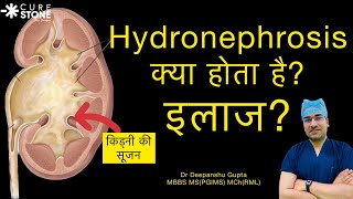 Hydronephrosis Treatment in Hindi क्या होता है kidney की सूज़न HYDRONEPHROSIS Dr Deepanshu Gupta [upl. by Egide]