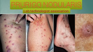 What is prurigo nodularis and how to management it [upl. by Tiras697]