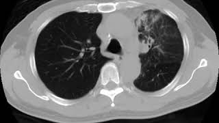 Lymphangitis carcinomatosis Ahuja AT et al 2017 Book Essential Radiology [upl. by Kimura579]