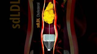 Angioplasty Heart Attack MI  3D Animation shorts trending [upl. by Gerhardt875]