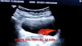 Ultrasound of RT vesico ureteric stone [upl. by Romain]