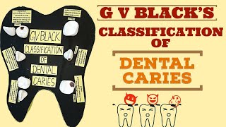 Classification of Dental Caries GV Blacks Classification  Model for PHD dental [upl. by Andre]