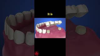 Tooth supported fixed bridge instalation process health wellness shorts [upl. by Charo]