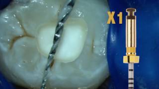 ProTaper Next™ Technique with Dr Scianamblo  Dentsply Sirona [upl. by Formenti]