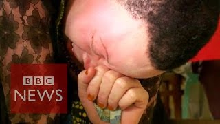 Albinos in Tanzania killed like animals [upl. by Enaj739]