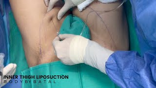 Inner Thigh Liposuction  Awake Liposuction [upl. by Nolita]