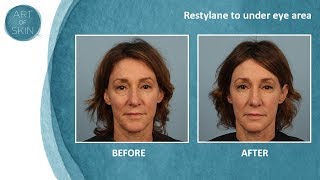 Undereye filler with Restylane Dr Palm San Diego [upl. by Rohclem]