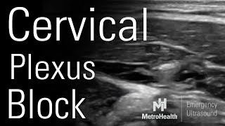 Cervical Plexus Block [upl. by Anol]