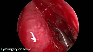 Middle turbinate concha bullosa excision [upl. by Dorsman]