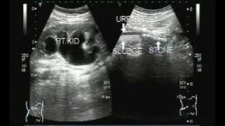 Ultrasound Video showing sludge and Stone in Ureter [upl. by Gerty707]