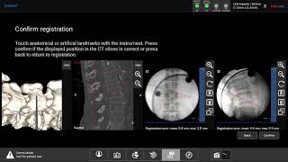 CT  CArm  Angio RegistrationFusion for Surgical Navigation ERGOSURG GmbH Ismaning Germany [upl. by Birck518]