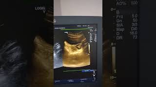 Hemorrhagic Cyst in Lt Ovary Ultrasound [upl. by Eelsha]