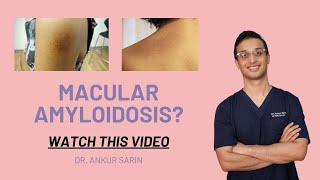 Macular Amyloidosis Skin Treatment  Macular amyloidosis Hindi  Dr Ankur Sarin [upl. by Kcolttam]