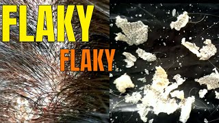 BIG FLAKES  Scalp Psoriasis Removal [upl. by Mosenthal423]