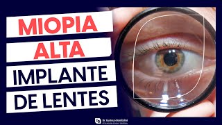 Correção de alta miopia e alto astigmatismo Implante de Lente Intraocular Fácica  Dr Gustavo [upl. by Falkner]